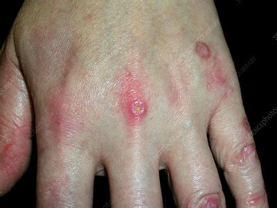 Dermatomyositis - Stock Image - C056/0911 - Science Photo Library