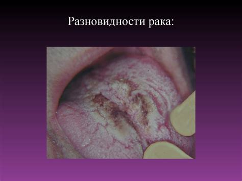Рак языка - презентация онлайн