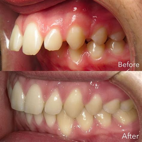 Overjet vs Overbite