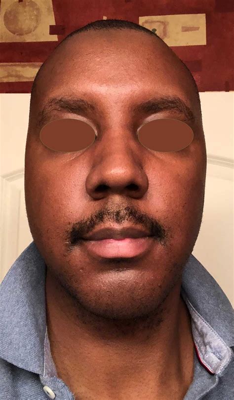 Jowl Treatment with a Face Lift Dr. Philip Young In Seattle & Bellevue