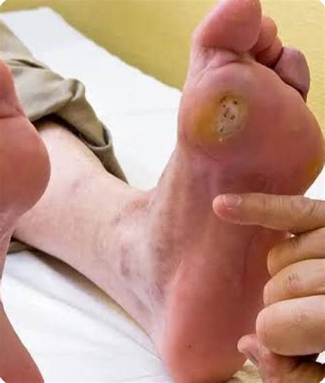diabetic foot ulcer treatment  hyderabad  care specialists