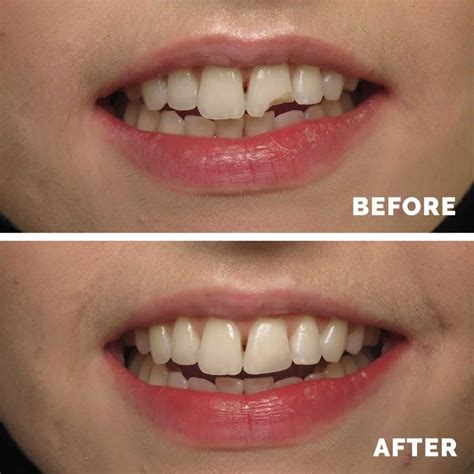 composite fillings comfort dentistry cosmetic family dentist