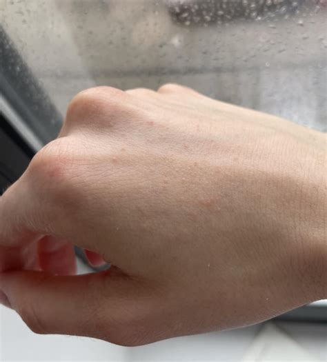 Does anyone know what these small bumps on my hand are? : r ...