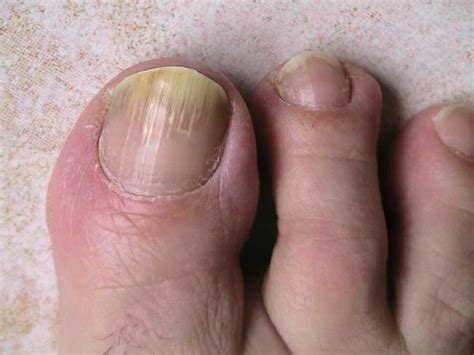 Pharmacie thermale - La mycose des ongles