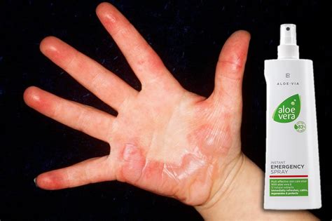 SOS Спрей за спешна помощ Алое Вера от LR - Emergency spray Aloe Vera ...
