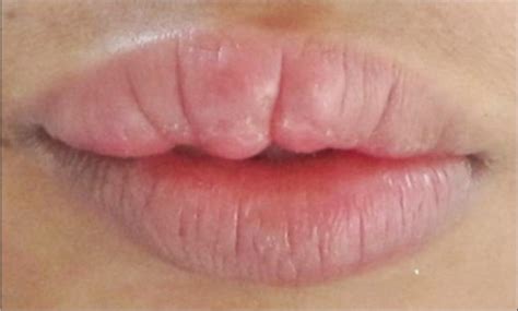 pre treatment appearance   upper lip  scientific diagram