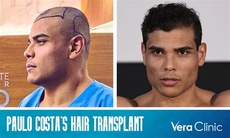 Paulo Costa Hair Transplant Journey