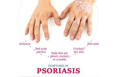 Symptoms of Psoriasis