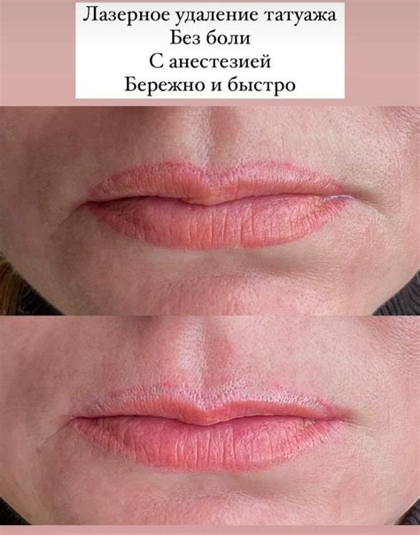 Удаление татуажа