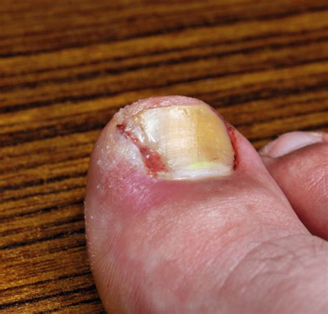 10 Alarming Signs of Diabetes Foot Complications - Diabetes Fixer