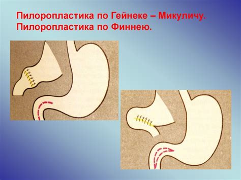 Oslozhnenia_yazvennoi_774_bolezni_vse - online presentation