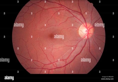 fundus eye