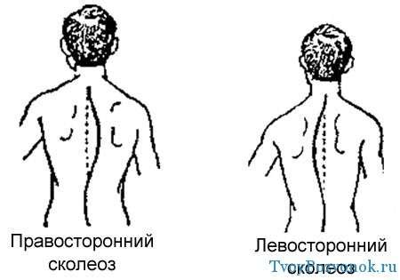 Правосторонний сколиоз – как проявляется, как выпрямить, лечение