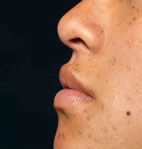 brown spot removal  indianapolis  laser light