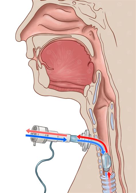 Illustrations tracheostomy management - MedicalGraphics