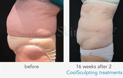 Before & After CoolSculpting Fat Freezing Treatment