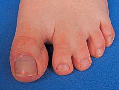Fused Toes | Offices in Arlington, Dallas, Frisco, McKinney TX
