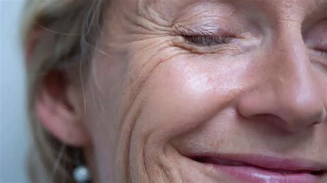 How to Get Rid of Smile Lines: Tips for a Youthful, Radiant Smile