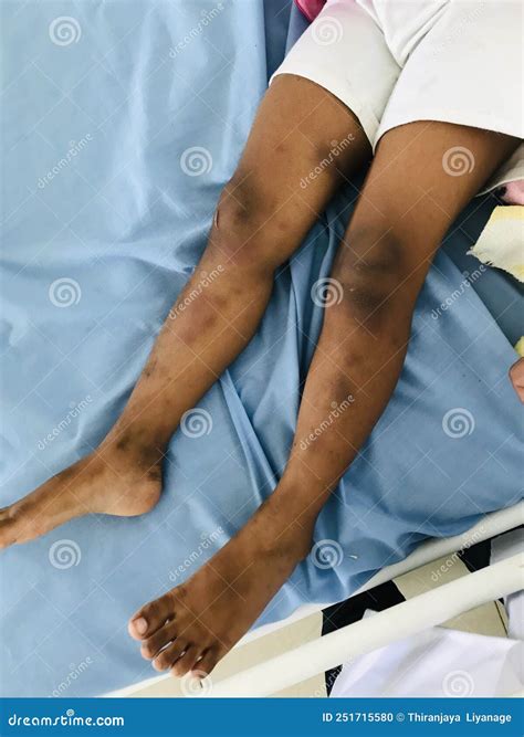 Immune Thrombocytopenic Purpura Stock Photo - Image of chest, legs