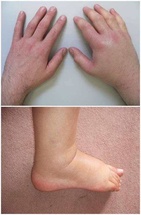 Ventilator Body Swelling at Carly Decosta blog