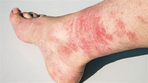 Diabetic Sores on Legs: Causes, Diagnosis, and Prevention Tips