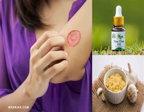 Unlocking the Power of Natural Remedies for Ringworm at Home - mehkan.com