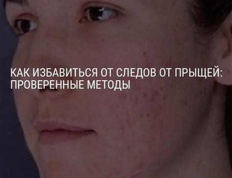 Как избавиться от следов от прыщей: рекомендации, позволяющие убрать ...