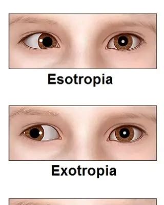 Strabismus surgery - An Eye Care Blog