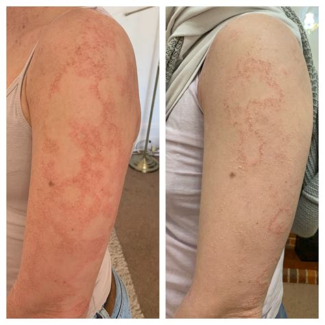 Viral Skin Infections