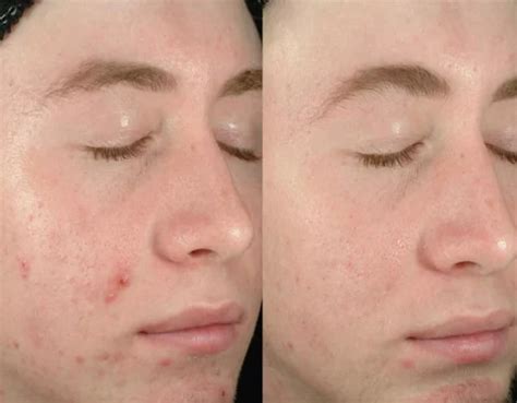 BBL Forever Clear Acne Treatments | Cutis Dermatology