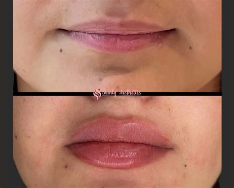 Lips Too Full After Filler at Aileen Markham blog
