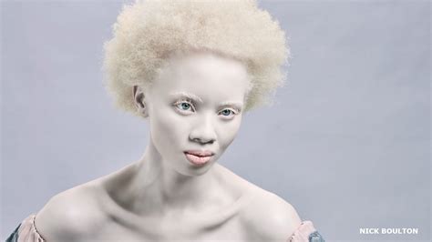 BBC - Living with albinism