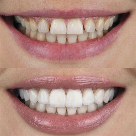 What is the No-Prep Veneers Cost in Turkey?