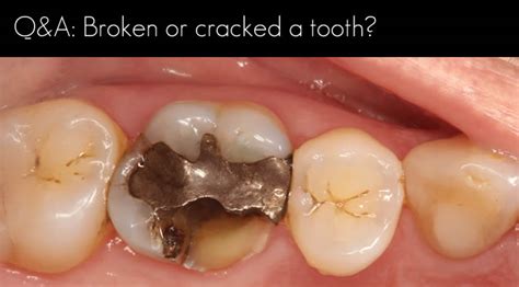 broken molar