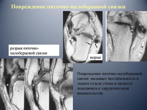 МРТ голеностопного сустава и стопы 2012г - презентация онлайн