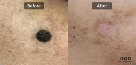 Before and After Images of Seborrheic Keratoses Removal