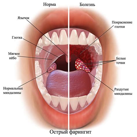 Абсцесс горла: фото, симптомы и лечение