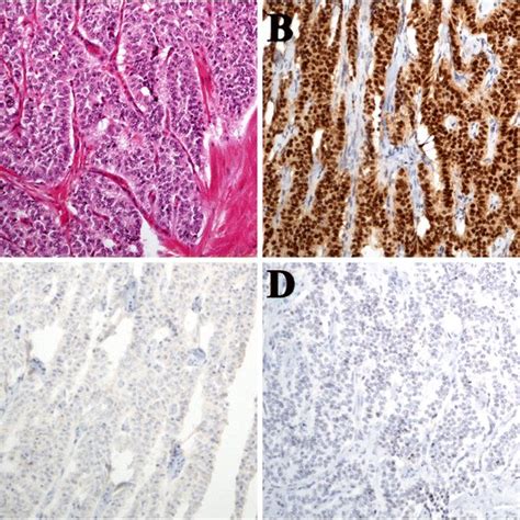 typical carcinoid  central location polygonal  cuboidal cell