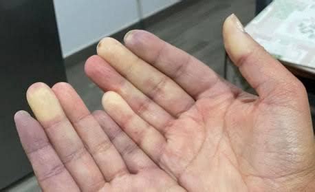 Dedos Roxos O Que Pode Ser - Dedos roxos no frio? - Dra. Daniele Scherer