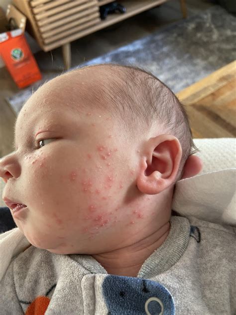 Terrible Newborn Acne! Any tips? How long will it last? : r/newborns