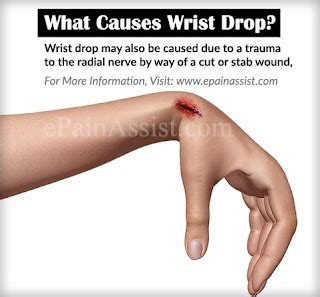 Wrist drop - #medical article #anatomy - LANKA STUDENTS