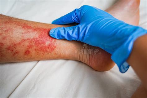 Vermelhidão Na Canela Da Perna - Eczema Doença Cutânea Nas Pernas Erupções E Manchas Vermelhas Com ...