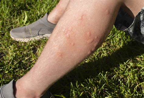 What Blood Type Do Mosquitoes Like Best?