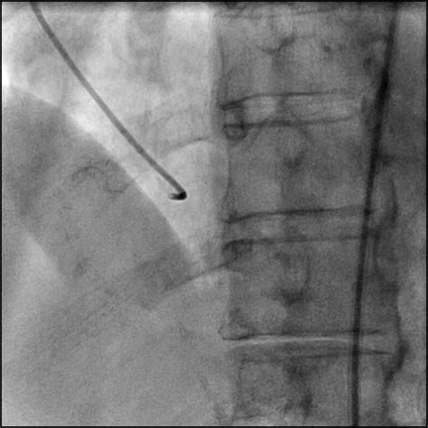 Dissection Type C - Case 2 - Cardiology Apps