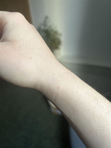 Do these look like scabies bites? : r/scabies