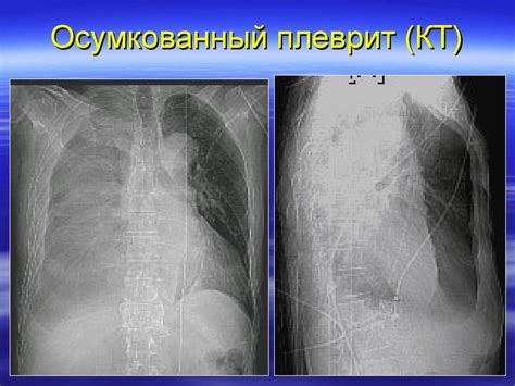 Лучевая диагностика заболеваний плевры - презентация онлайн