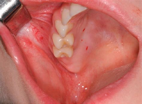 Patient 1. Before surgery. The first and the second upper right molar ...