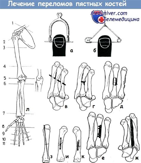 Лечение закрытых переломов пястных костей