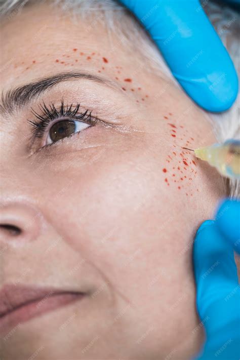 Premium Photo | Prp face injecting treatment cosmetic antiaging ...