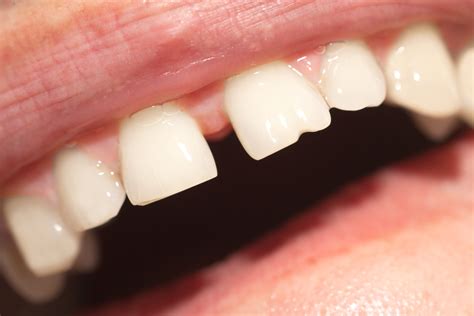 damaged tooth   dental emergency conroe tx